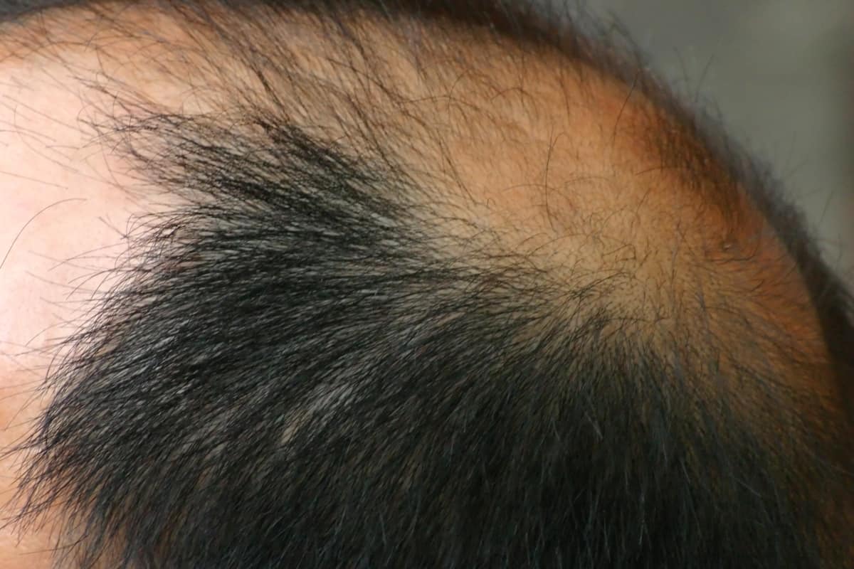 Androgenetic Alopecia In Men