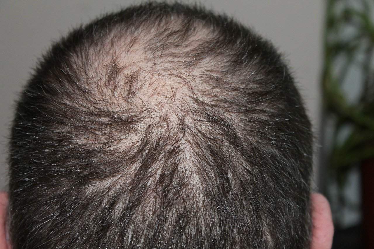 Is it ok to shave while using minoxidil?