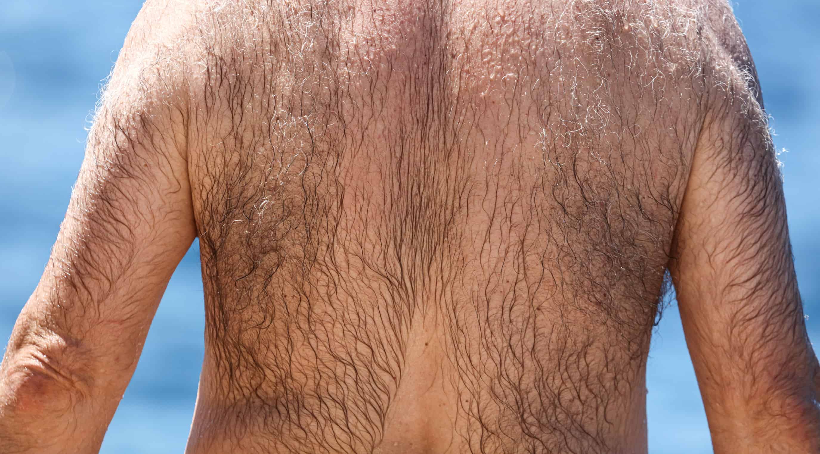 Back hair is generally body hair that causes embarrassment.